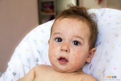 冬季宝宝患干燥性湿疹 怎么护理？
