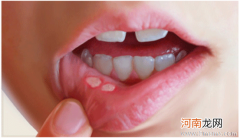 儿童口腔溃疡的诱发因素有哪些?