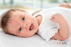婴幼儿湿疹的五类药物 新生儿湿疹用什么药好