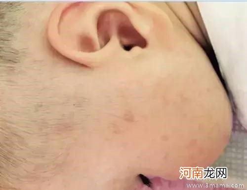 新生儿脸上有小红点怎么办？