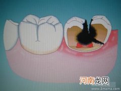 预防宝宝长蛀牙的方法