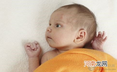 家长必看 宝宝湿疹症状及最佳治疗方法