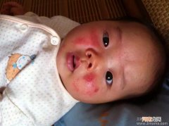 支招：宝宝脸上长湿疹怎么办？