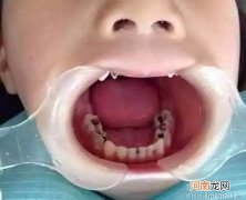 哪些原因会导致宝宝长虫牙