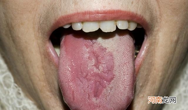 舌头长泡试试这2个小妙招 舌头上长泡是什么原因