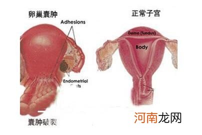 卵巢囊肿能对怀孕影响大吗 患有卵巢囊肿可以怀孕吗