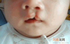 婴儿兔唇的原因有哪些