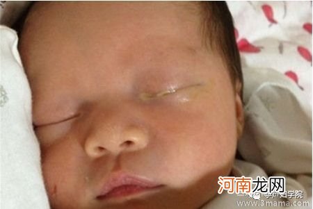 如何从眼屎判断宝宝健康？新生儿眼屎多的原因
