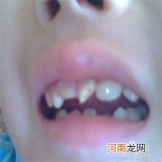 儿童换牙期间的注意事项