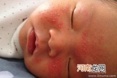 宝宝长湿疹的原因是什么呢？