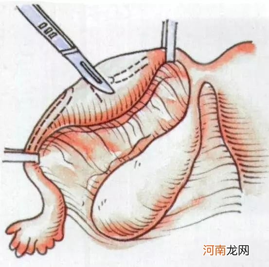 女性结扎后还能生育吗 女人结扎了能生育吗