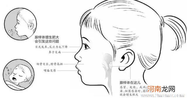 小儿打鼻鼾是属于病态状况吗