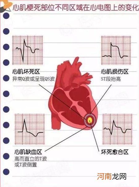 心肌梗塞的先兆和表现患者应注意的五个要点