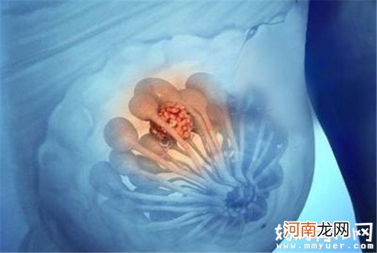 乳腺增生10个女人9个有！科普乳腺增生的原因及症状