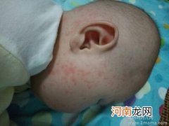 宝宝发烧后出疹子怎么办