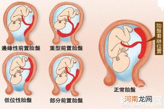 【胎盘前置】胎盘前置的后果 胎盘前置怎么治疗