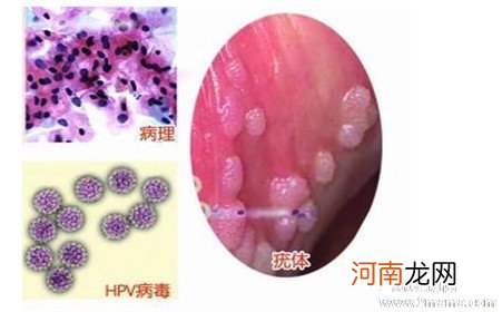 口腔尖锐湿疣症状