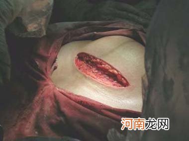 视频截图 剖腹产分娩全过程