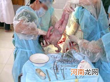 视频截图 剖腹产分娩全过程