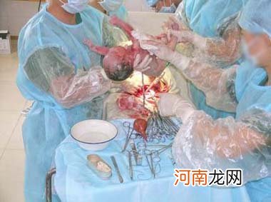 视频截图 剖腹产分娩全过程