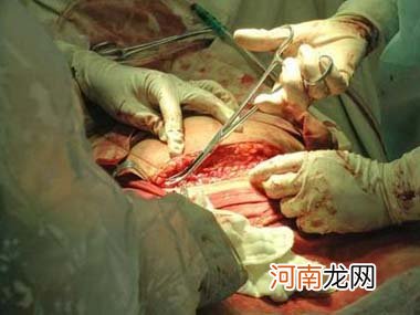 视频截图 剖腹产分娩全过程