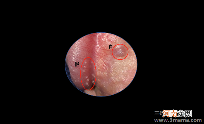 假性尖锐湿疣会痒吗