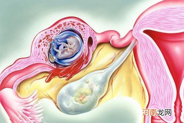 宫外孕症状早期hcg多少 宫外孕的诊断方法