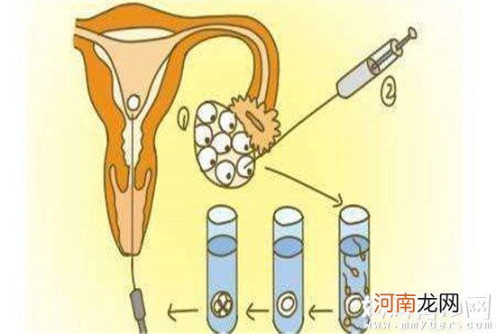 结扎被视为终极避孕措施 究竟男性结扎好还是女性结扎好