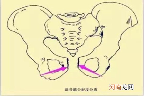 耻骨的酸痛有谁懂？孕晚期耻骨疼怎么办缓解记住5招