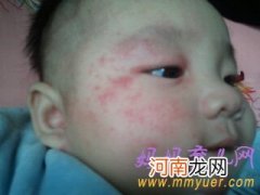 新生儿脸上有小红点是怎么回事？