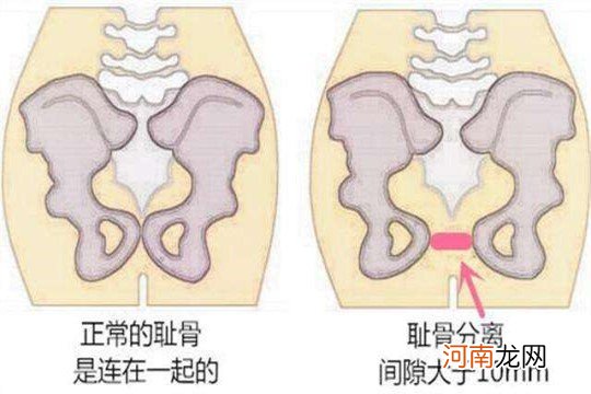 孕妇耻骨痛能不能顺产 是耻骨痛更痛还是顺产更痛