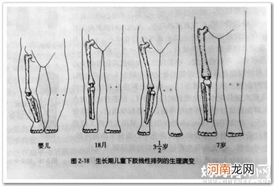 日常生活小tips：预防O型腿、X型腿