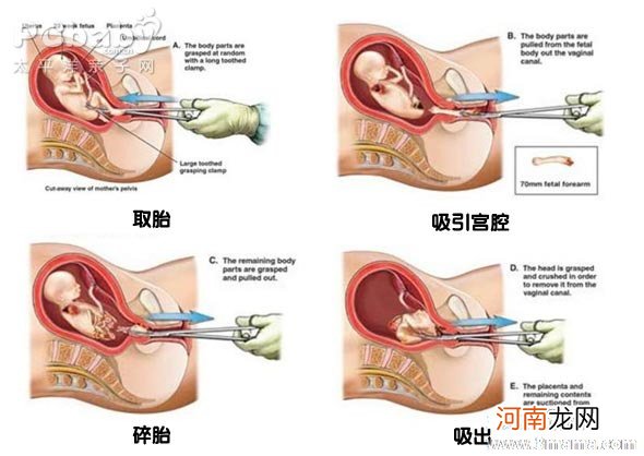 怀孕多久可以做人流