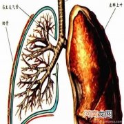 急性支气管炎的预防及护理措施