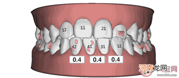 年龄越小戴牙套|年龄越小戴牙套效果越好吗 牙齿矫正的最佳年龄是几岁
