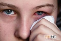 怎么鉴别眼睛痒和过敏性结膜炎