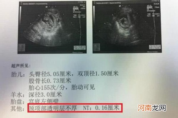 nt单子上有男女暗示fm nt值小于1一定是女孩吗？