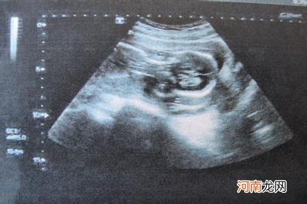 6一7周孕囊大小看男女 B超单子上的性别暗示