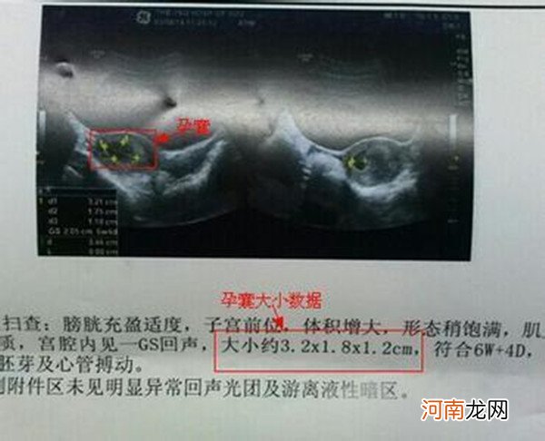 医生说大部分长孕囊都是男孩 有孕囊圆形生男孩的吗