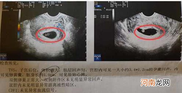 医生说大部分长孕囊都是男孩 有孕囊圆形生男孩的吗