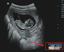 三个月胎儿宝宝的样子 怀孕三个月胎儿发育到什么程度