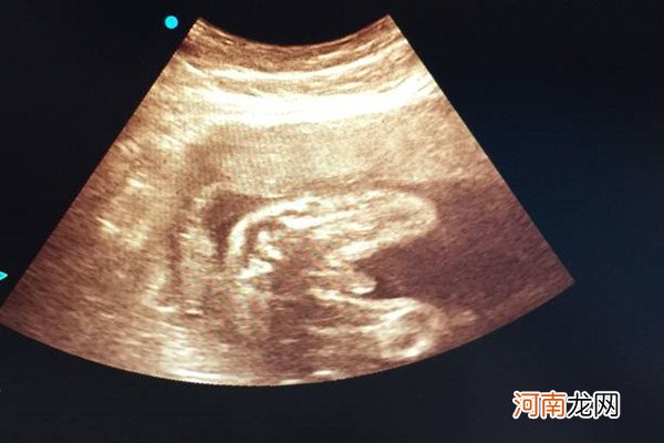 宝妈自述胎儿翻盘 来说说7个月女胎转男胎的感应