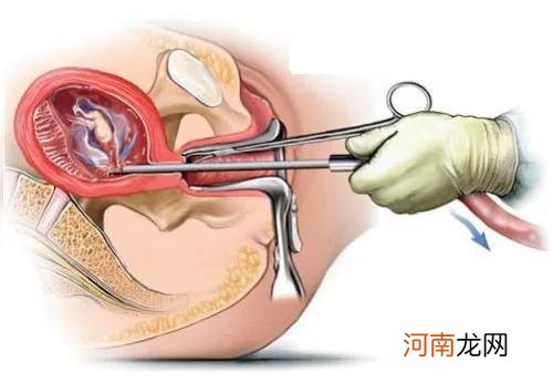 人流后宫腔粘连的概率 超导可视人流会宫腔粘连吗