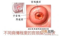 宫颈糜烂、宫颈糜烂的症状