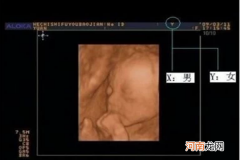 b超看胎儿性别图解 教你怎么从b超图像中看出宝宝性别