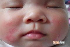 宝宝湿疹是怎么引起的5原因第二个最常见！