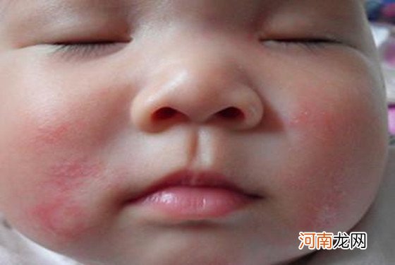 宝宝湿疹是怎么引起的5原因第二个最常见！