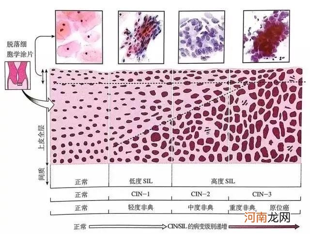 教你看TCT检查报告单 tct检查结果怎么看