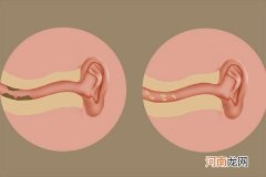 耳屎多是什么原因呢 耳屎是怎么产生的呢
