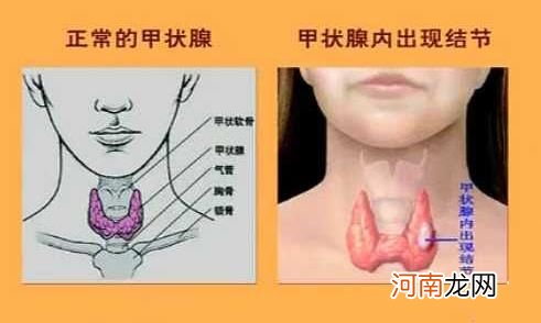 状腺结节的主要症状 甲状腺结节的主要症状有哪些甲